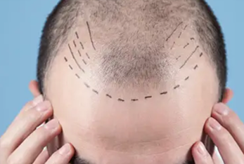 Hair transplant procedure for natural hair restoration